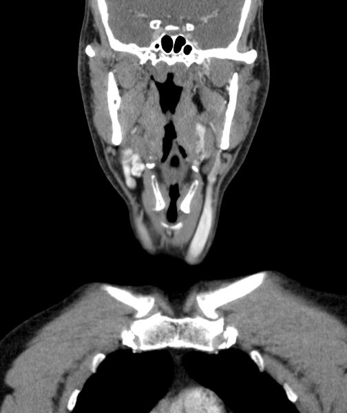 File:Bilateral carotid body tumors (Radiopaedia 52899-58827 B 2).jpg
