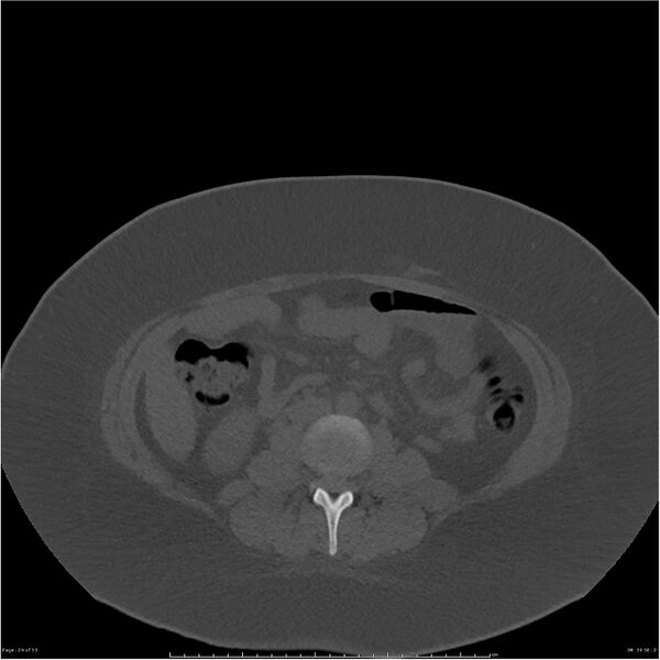File:Bilateral lumbar ribs (Radiopaedia 25862-26010 bone window 24).jpg