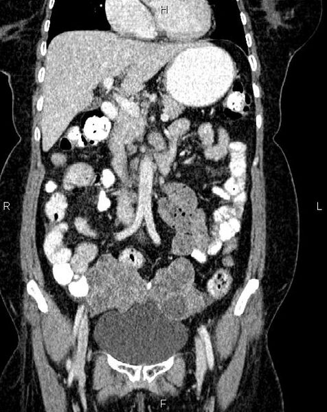 File:Bilateral ovarian serous cystadenocarcinoma (Radiopaedia 86062-101989 D 15).jpg