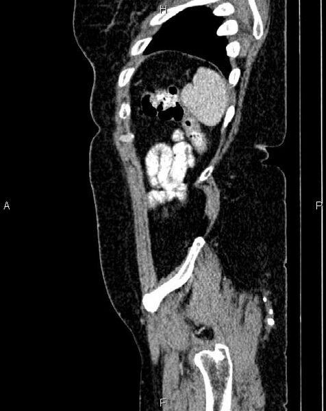 File:Bilateral ovarian serous cystadenocarcinoma (Radiopaedia 86062-101989 E 79).jpg