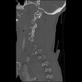 Bilateral perched facets with cord injury (Radiopaedia 45587-49713 Sagittal bone window 12).jpg