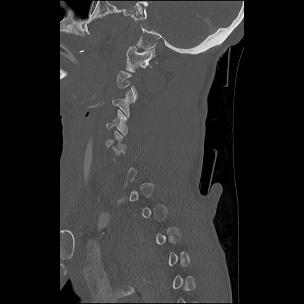 File:Bilateral perched facets with cord injury (Radiopaedia 45587-49713 Sagittal bone window 12).jpg