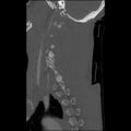Bilateral perched facets with cord injury (Radiopaedia 45587-49713 Sagittal bone window 40).jpg