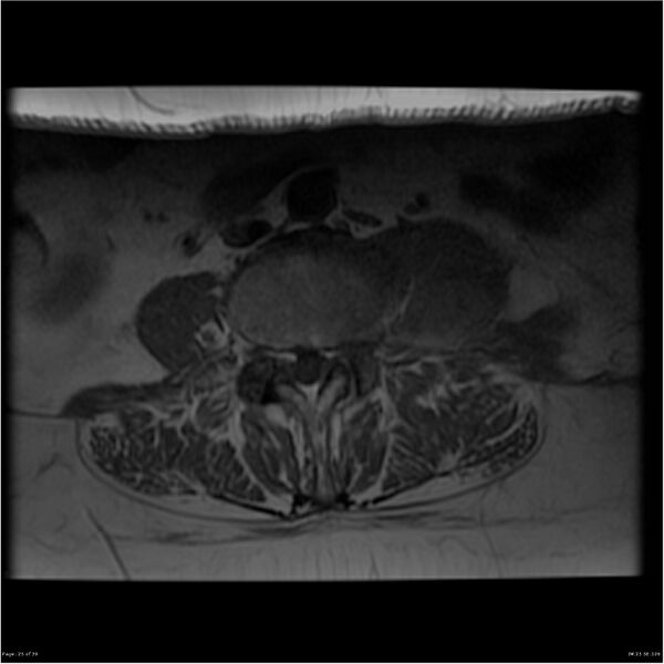 File:Bilateral psoas hematomas (Radiopaedia 24057-24280 T1 25).jpg