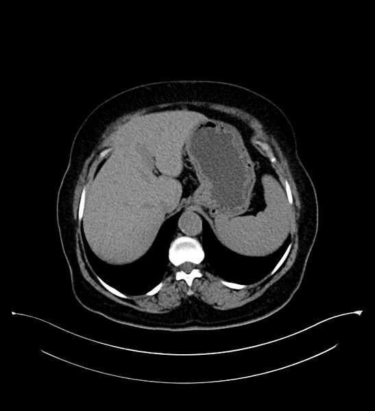 File:Bilateral sporadic synchronous clear cell renal cell carcinoma (Radiopaedia 85035-100575 Axial non-contrast 16).jpg