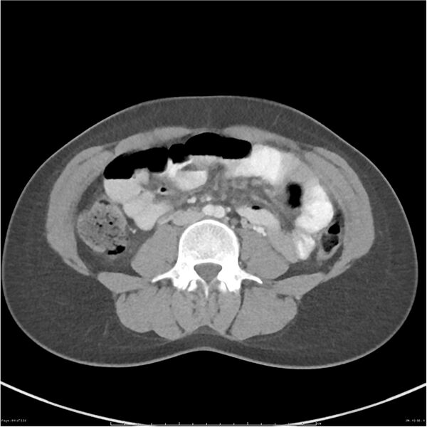 File:Bilateral ureteritis and cystitis (Radiopaedia 25340-25594 A 41).jpg