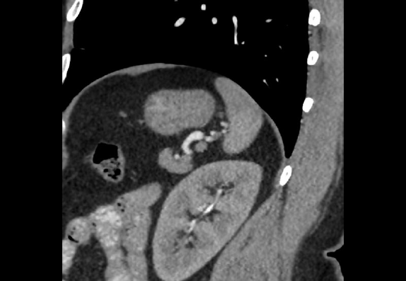File:Bilateral urolithiasis with incidentally detected splenic artery aneurysm and left inferior vena cava (Radiopaedia 44467-48127 Ob. Sag. C+ Art. 2).jpg