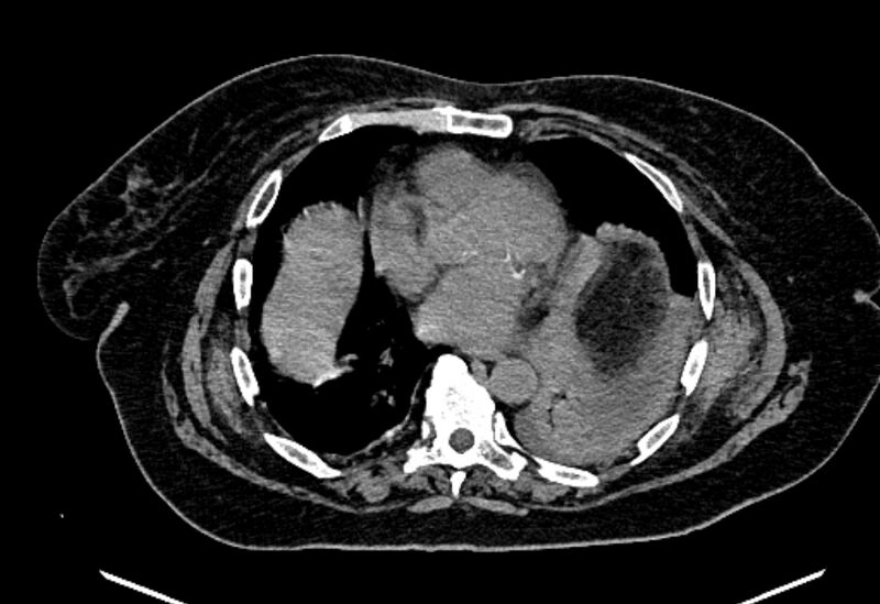 File:Biliary pancreatitis (Radiopaedia 72289-82823 Axial non-contrast 13).jpg