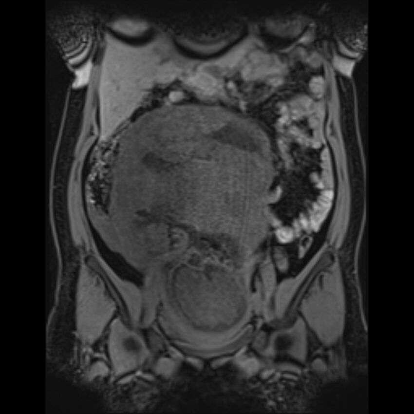 Bilobed placenta accreta (Radiopaedia 69648-79591 Coronal T1 vibe 84).jpg