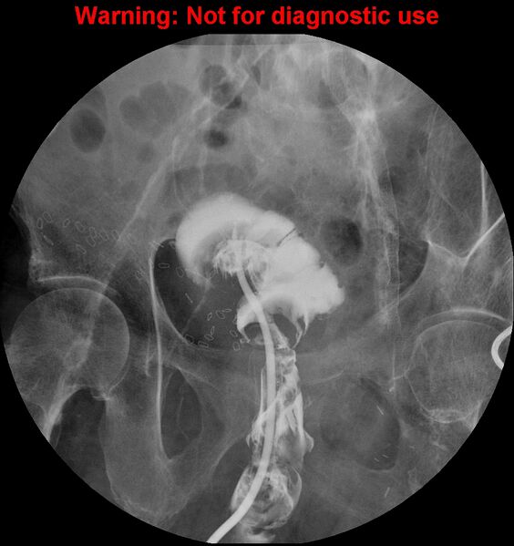File:Bladder rupture (intraperitoneal) (Radiopaedia 41057-43807 cystogram 6).jpg