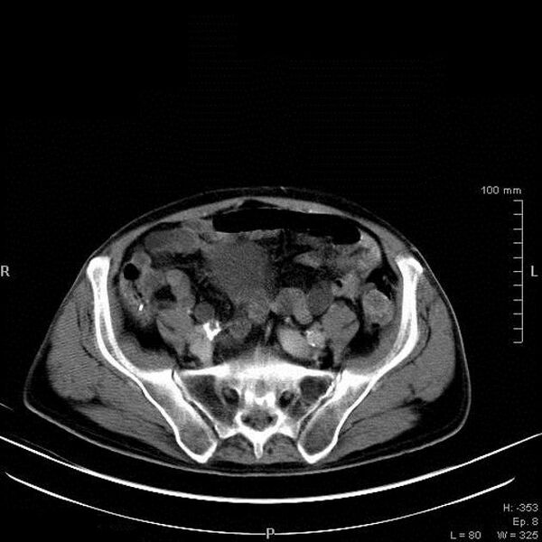 File:Bladder squamous cell carcinoma (Radiopaedia 14130-13984 B 1).jpg