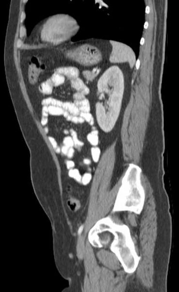 File:Bleeding duodenal ulcer and adenomyomatosis of gallbladder (Radiopaedia 61834-69861 C 72).jpg