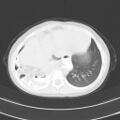 Bochdalek diaphragmatic hernia (Radiopaedia 38866-41059 Axial lung window 19).jpg