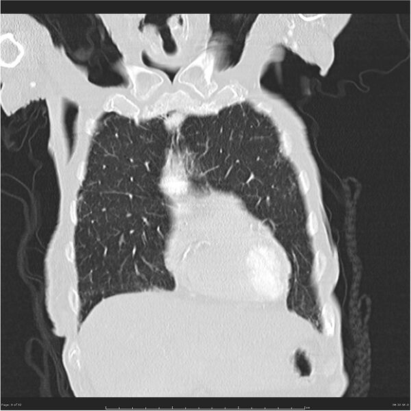 File:Boerhaave syndrome (Radiopaedia 26240-26362 Coronal lung window 6).jpg