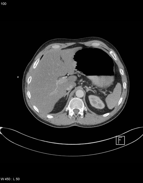 File:Boerhaave syndrome with tension pneumothorax (Radiopaedia 56794-63605 A 49).jpg