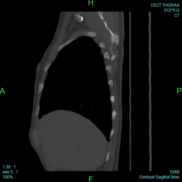 File:Bone metastases from lung carcinoma (Radiopaedia 54703-60937 Sagittal bone window 15).jpg