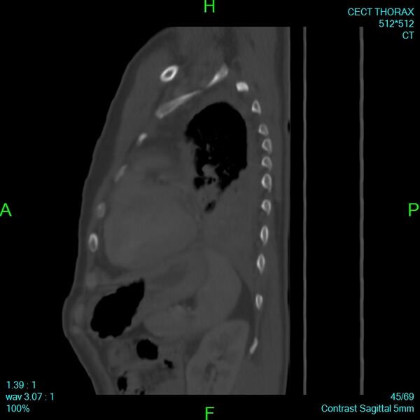 File:Bone metastases from lung carcinoma (Radiopaedia 54703-60937 Sagittal bone window 45).jpg