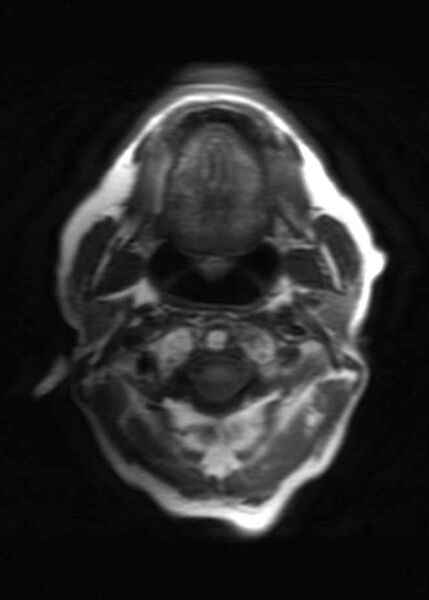 File:Brain metastases from squamocellular lung cancer (Radiopaedia 56515-63222 Axial T1 1).jpg