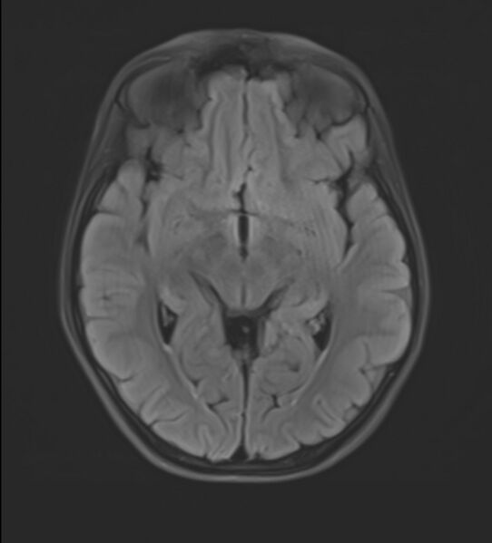 File:Brainstem glioma (Radiopaedia 70548-80674 Axial FLAIR 12).jpg