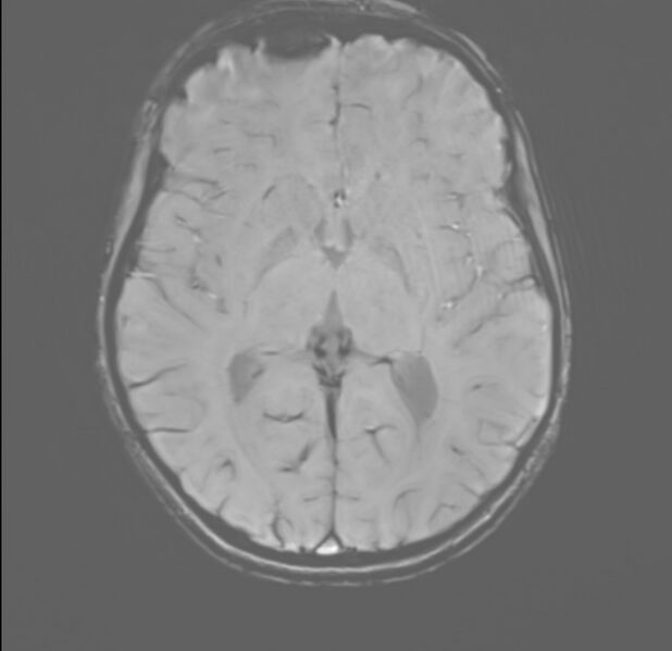 File:Brainstem glioma (Radiopaedia 70548-80674 Axial SWI 32).jpg