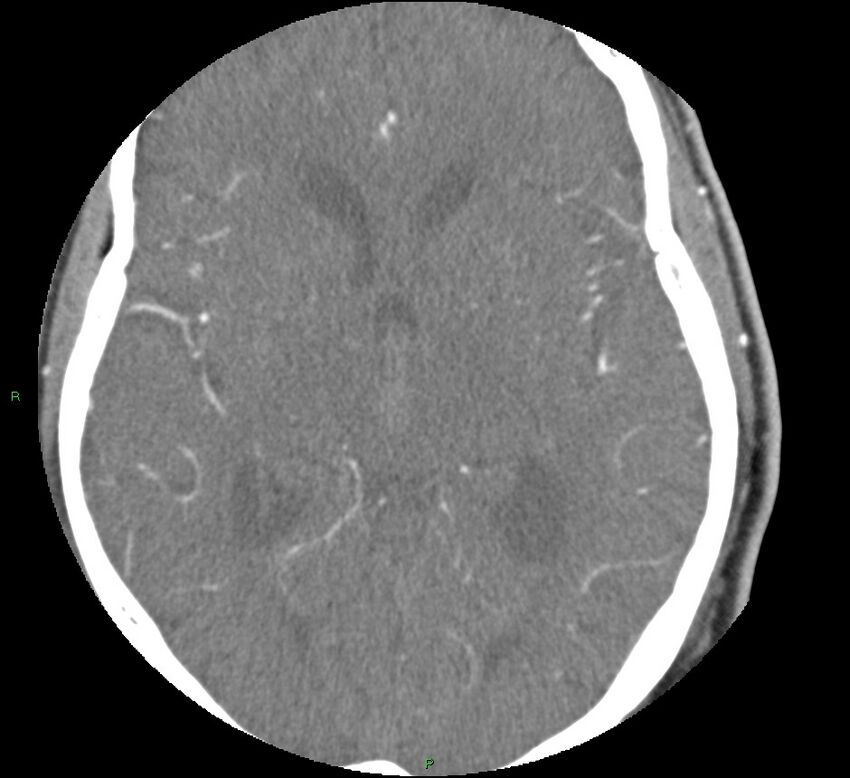Brainstem hemorrhage (Radiopaedia 58794-66028 D 95).jpg
