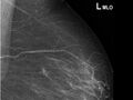 Breast cancer - spiculated mass occult on ultrasound (Radiopaedia 62220-70499 MLO 1).jpeg
