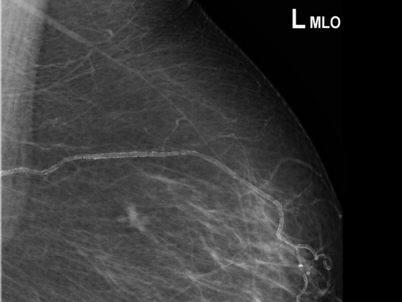 File:Breast cancer - spiculated mass occult on ultrasound (Radiopaedia 62220-70499 MLO 1).jpeg