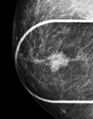 Breast cancer and multiple circumscribed masses (Radiopaedia 62456-70699 RCC spot 1).jpeg