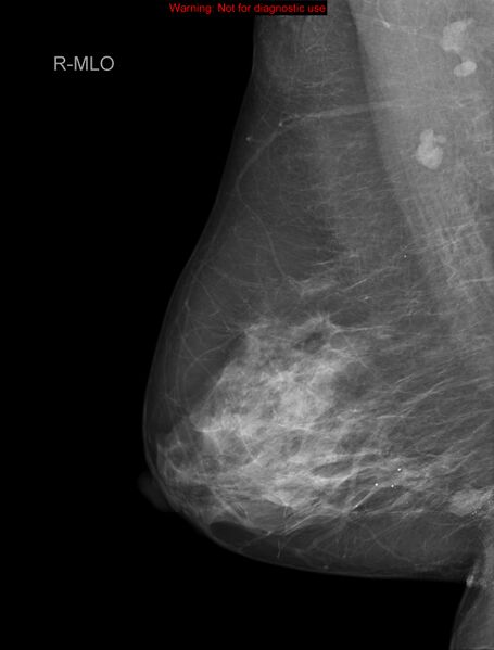 File:Breast carcinoma (multicentric multifocal in mammary Paget disease) (Radiopaedia 50966-56507 MLO 1).jpg