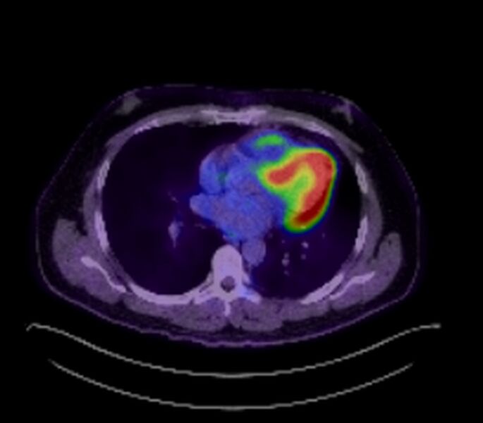 File:Bronchial carcinoid tumor (Radiopaedia 67377-76766 18FDG-PET-CT 29).jpg