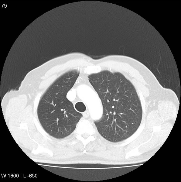 File:Bronchial carcinoid tumor with right lower lobe collapse (Radiopaedia 29060-29422 B 17).jpg