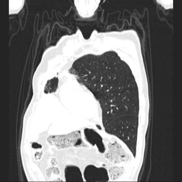 File:Bronchopleural fistula - postoperative complication (Radiopaedia 21020-20947 Coronal lung window 7).jpg