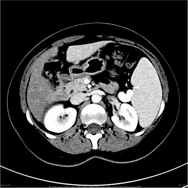 File:Budd-Chiari syndrome (Radiopaedia 27929-28177 Axial liver window 25).JPG