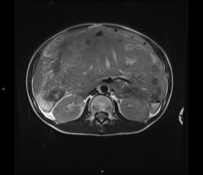 File:Burkitt lymphoma (bowel) (Radiopaedia 68839-78557 Axial T2 26).jpg