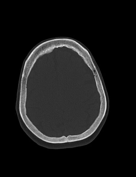File:Burnt-out meningioma (Radiopaedia 51557-57337 Axial bone window 36).jpg
