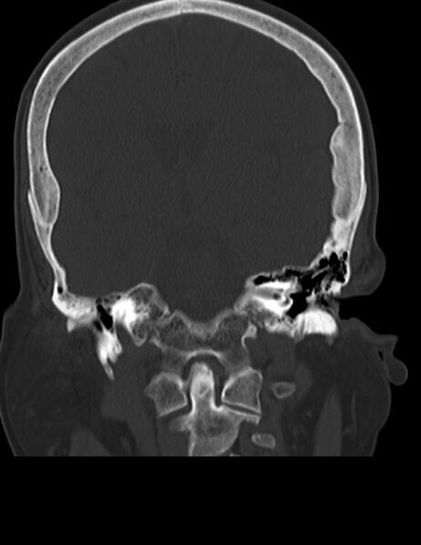 File:Burnt-out meningioma (Radiopaedia 51557-57337 Coronal bone window 28).jpg