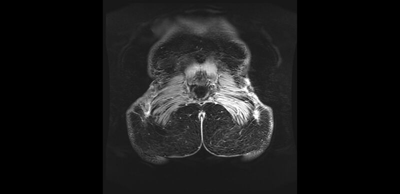 File:Buttock filler complications (Radiopaedia 63497-72115 Coronal T1 C+ 56).jpg