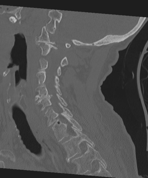 File:C2 fracture with vertebral artery dissection (Radiopaedia 37378-39199 Sagittal bone window 32).png