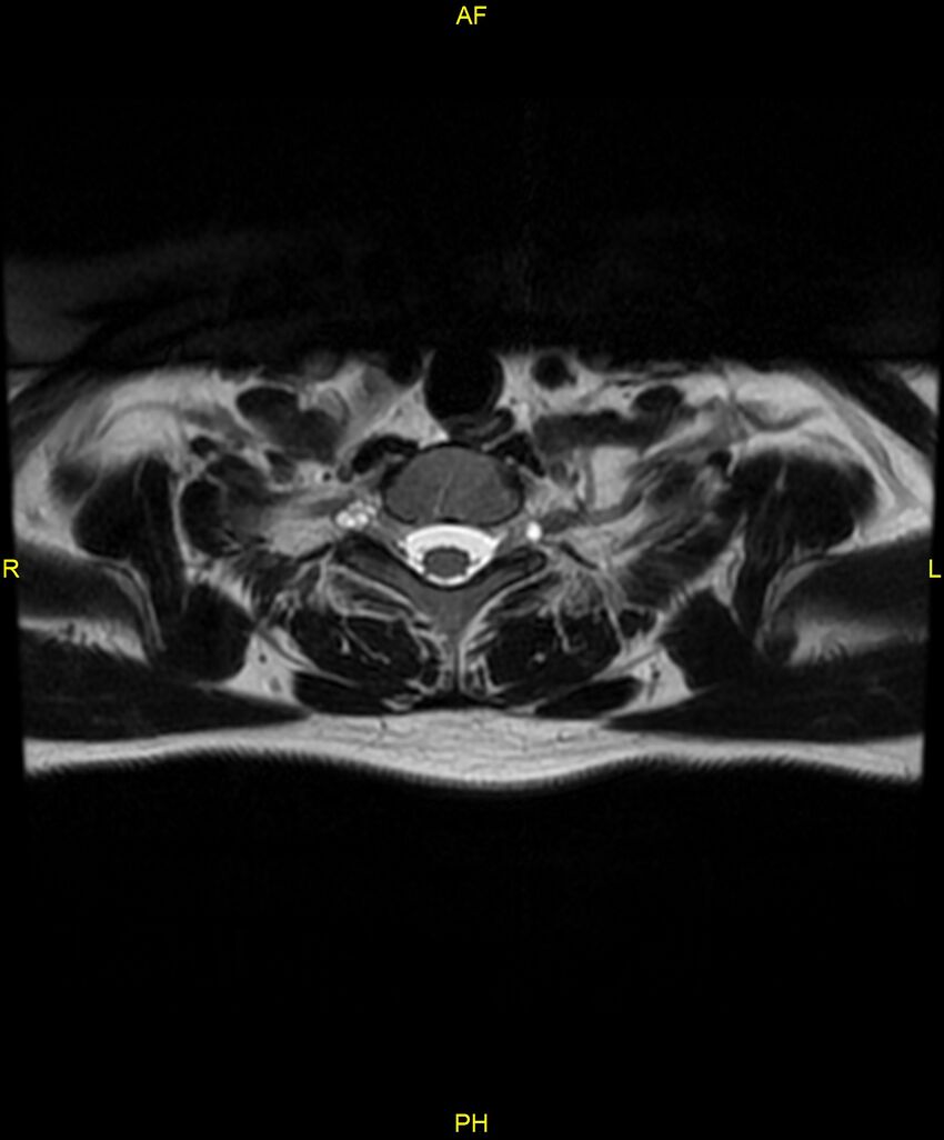 C5 nerve sheath tumor (Radiopaedia 85777-101596 Axial T2 79).jpg