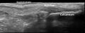 Calcaneal tuberosity avulsion fracture - ultrasound (Radiopaedia 29978-30524 E 1).jpg