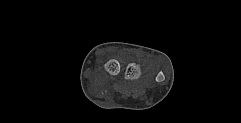 File:Calcifying aponeurotic fibroma (Radiopaedia 88423-105064 Axial bone window 46).jpg