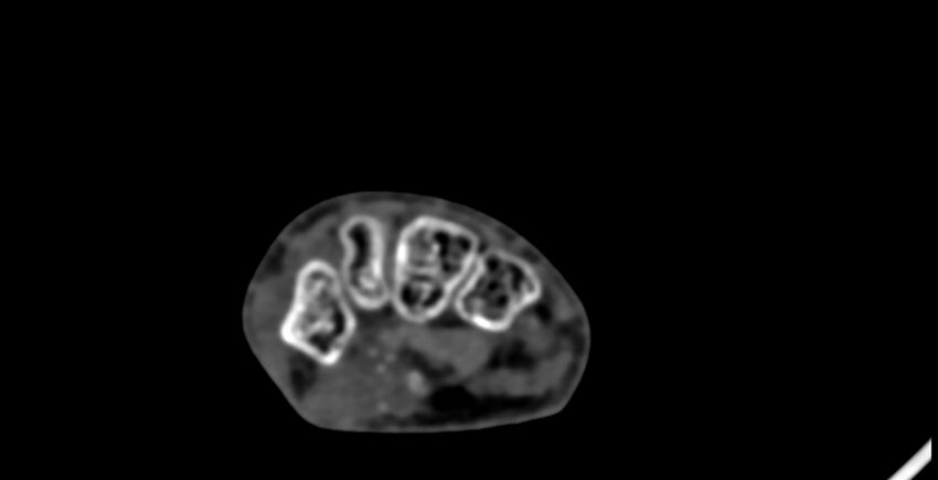 Calcifying aponeurotic fibroma (Radiopaedia 88423-105064 B 99).jpg
