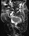 Cancer cervix - stage IIb (Radiopaedia 75411-86615 Sagittal ADC 14).jpg