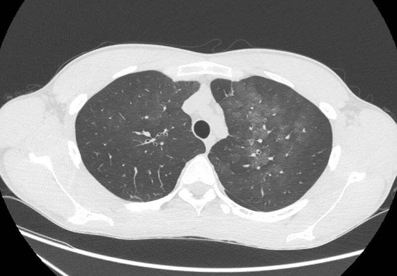 File:Cannabis-induced diffuse alveolar hemorrhage (Radiopaedia 89834-106946 Axial lung window 28).jpg