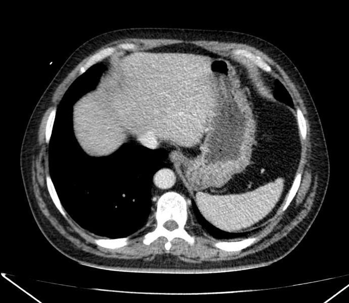 File:Carcinoid tumor with hepatic metastases (Radiopaedia 22651-22670 C 29).jpg