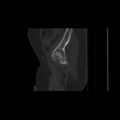 Carcinoma cervix- brachytherapy applicator (Radiopaedia 33135-34173 Sagittal bone window 15).jpg