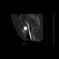 Carcinoma cervix- brachytherapy applicator (Radiopaedia 33135-34173 Sagittal bone window 88).jpg