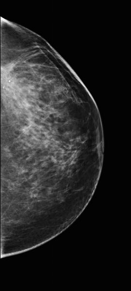 File:Carcinoma left breast (Radiopaedia 30017-30573 A 1).png