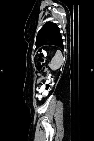 File:Carcinoma of uterine cervix (Radiopaedia 85861-101700 D 75).jpg