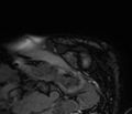 Cardiac amyloidosis (Radiopaedia 39736-42124 F 12).jpg